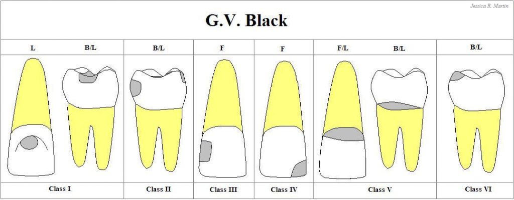 Klasifikasi Karies Gigi Menurut G. V. Black